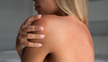 Ακμή στην πλάτη: Γιατί εμφανίζεται και πώς μπορείτε να την αντιμετωπίσετε