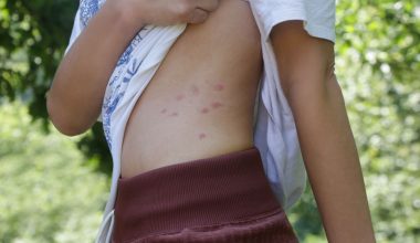 Τσιμπήματα κοριών: Τα σημάδια που δείχνουν ότι υπάρχουν στο κρεβάτι σα