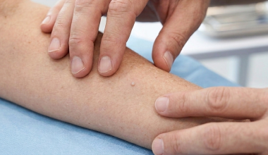 Αυτός είναι ο πιο συνηθισμένος τύπος καρκίνου του δέρματος: Tα σημάδια που μπορεί εύκολα να αγνοήσετε