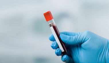 Αλτσχάιμερ: Ο FDA έδωσε το «πράσινο φως» για νέα εξέταση αίματος