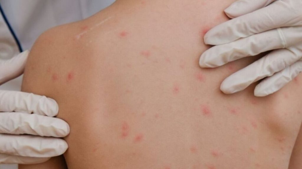 Για πρώτη φορά μετά από 35 χρόνια σημειώθηκαν θάνατοι από ιλαρά στην Πελσιβάνια