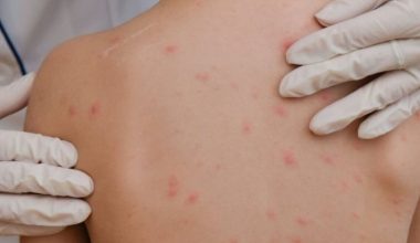 Για πρώτη φορά μετά από 35 χρόνια σημειώθηκαν θάνατοι από ιλαρά στην Πελσιβάνια