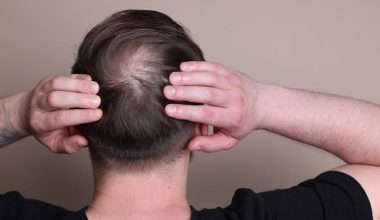 Γυροειδής αλωπεκία: Νέα θεραπεία μπορεί να επαναφέρει τα μαλλιά – Εντυπωσιακά αποτελέσματα σε κλινικές δοκιμές