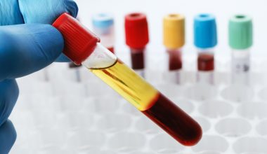 Γ.Μαζωνάκης: Τι είναι η πλασμαφαίρεση – Πότε μπορεί να οδηγήσει σε καρδιακή ανακοπή