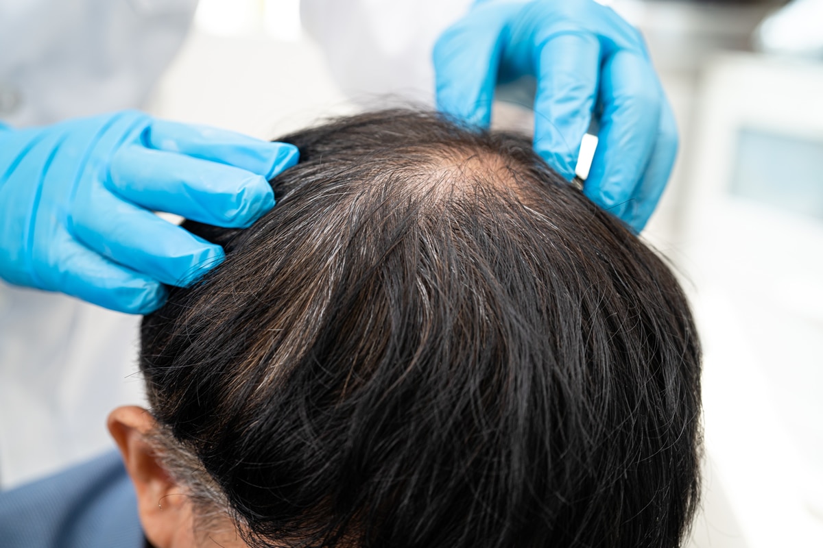 Χάνετε μαλλιά; Το σημείο της αραίωσης μπορεί να λέει περισσότερα
