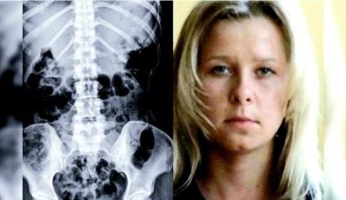 Ν.Ντέμκινα: Η Ρωσίδα που λέει ότι μπορεί να βλέπει μέσα στο ανθρώπινο σώμα – Το πείραμα που δίχασε